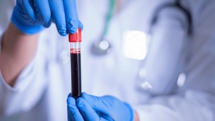 New blood test detects 90% of aggressive prostate cancer cases, beating current screenings